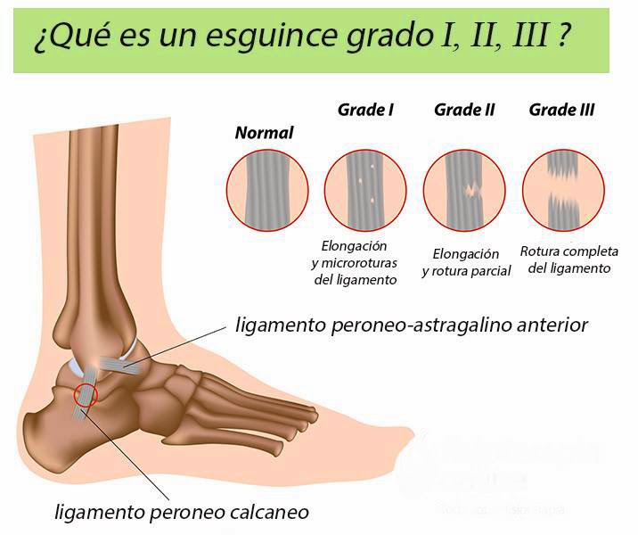 Venas varicosas icd 100